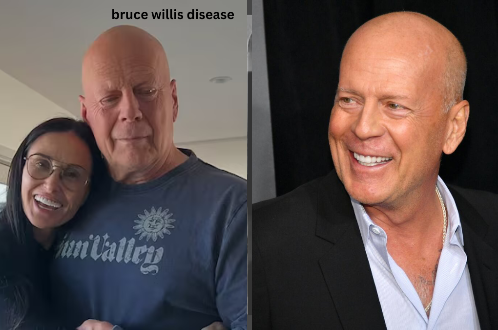 Bruce Willis Disease